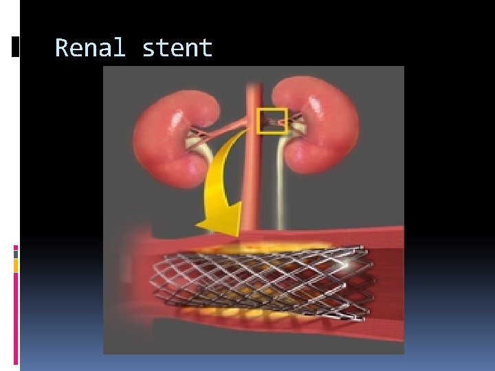 Renal stent 