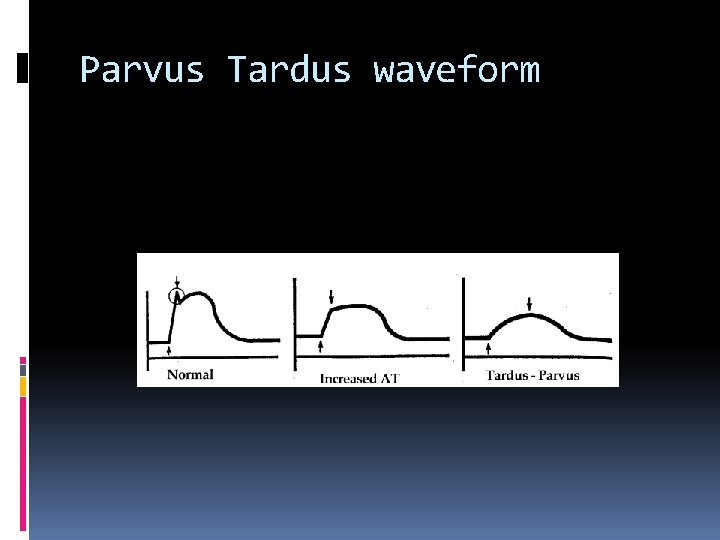 Parvus Tardus waveform 