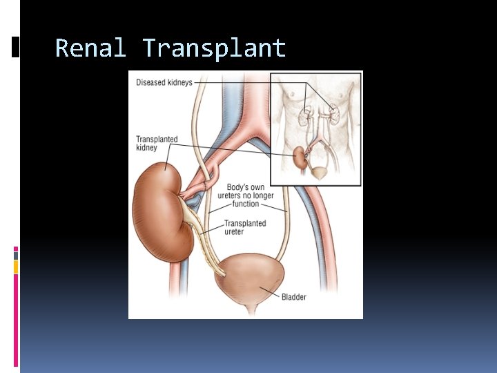 Renal Transplant 