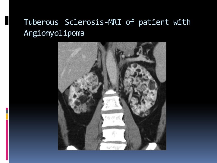 Tuberous Sclerosis-MRI of patient with Angiomyolipoma 