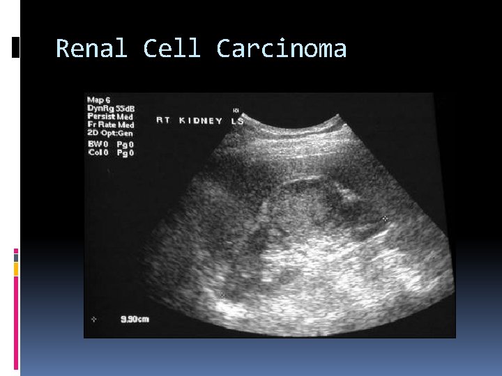 Renal Cell Carcinoma 