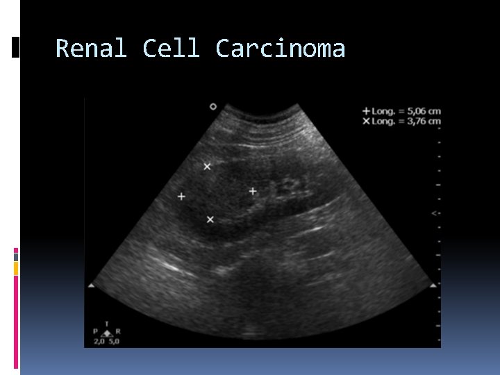 Renal Cell Carcinoma 