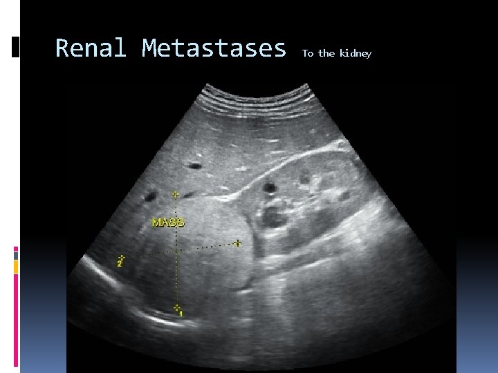 Renal Metastases To the kidney 