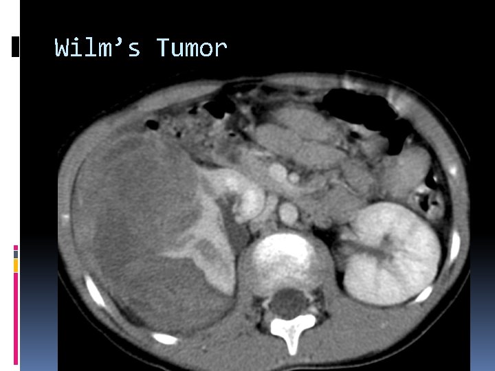 Wilm’s Tumor 
