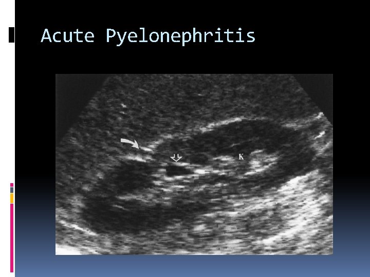 Acute Pyelonephritis 