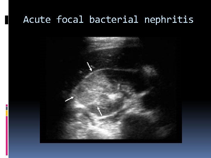 Acute focal bacterial nephritis 