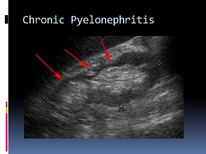 Chronic Pyelonephritis 
