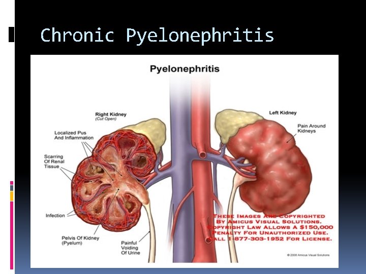 Chronic Pyelonephritis 