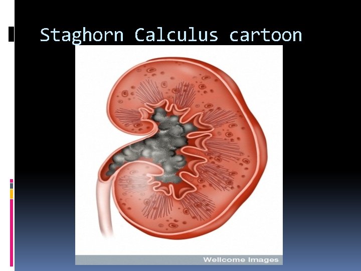 Staghorn Calculus cartoon 
