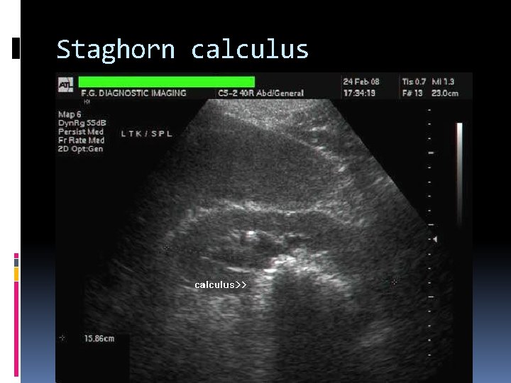 Staghorn calculus 