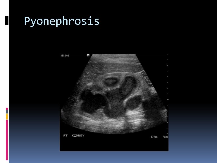 Pyonephrosis 