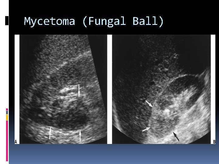 Mycetoma (Fungal Ball) 