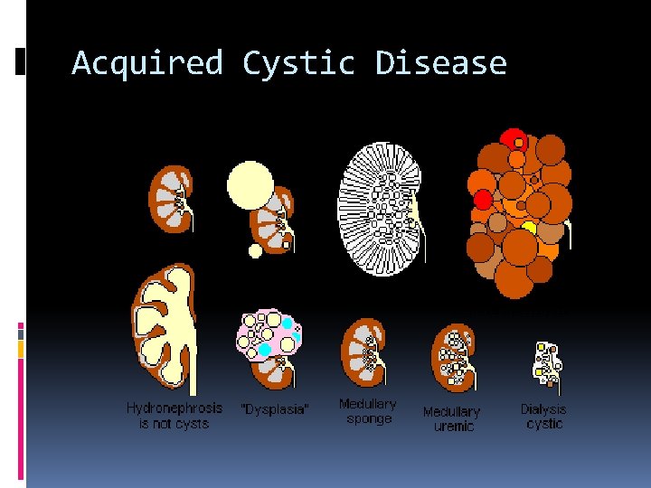 Acquired Cystic Disease 