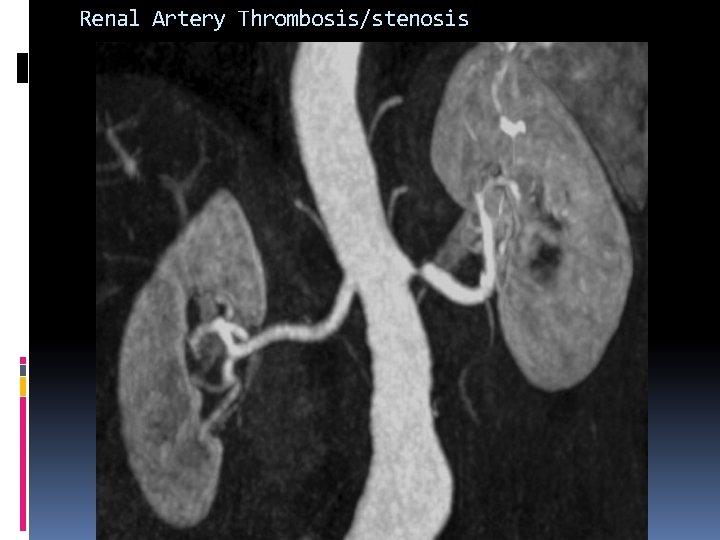 Renal Artery Thrombosis/stenosis 