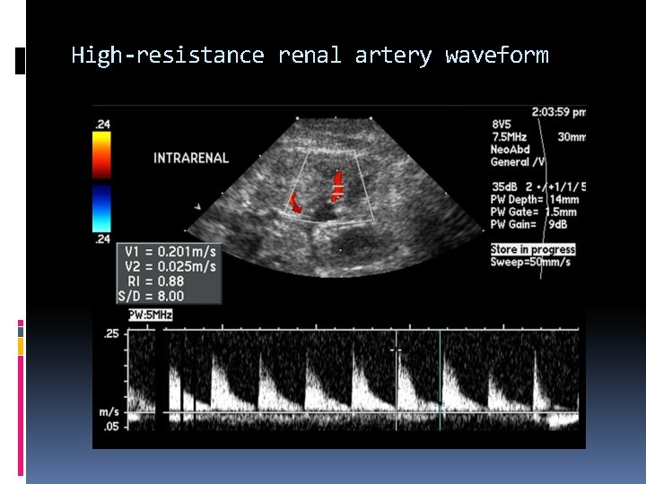 High-resistance renal artery waveform 