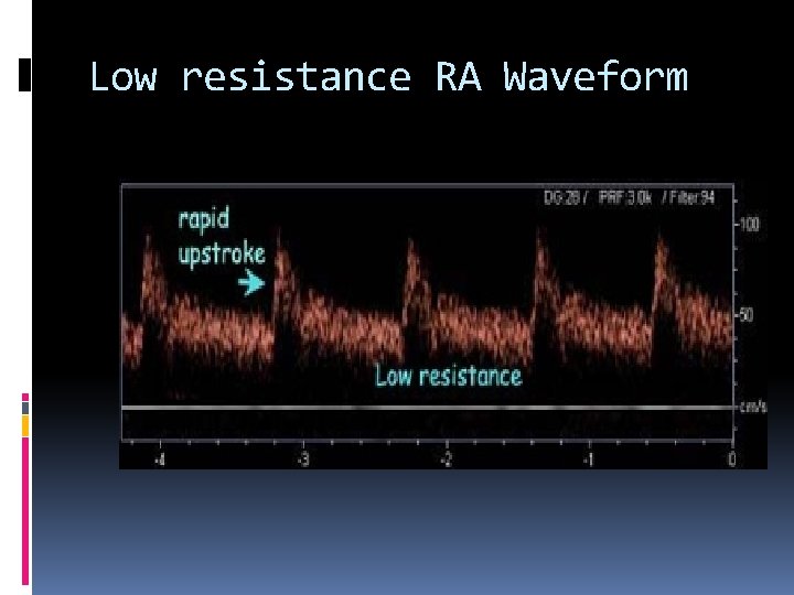 Low resistance RA Waveform 