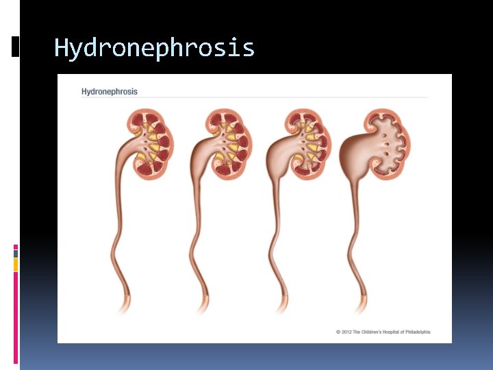 Hydronephrosis 