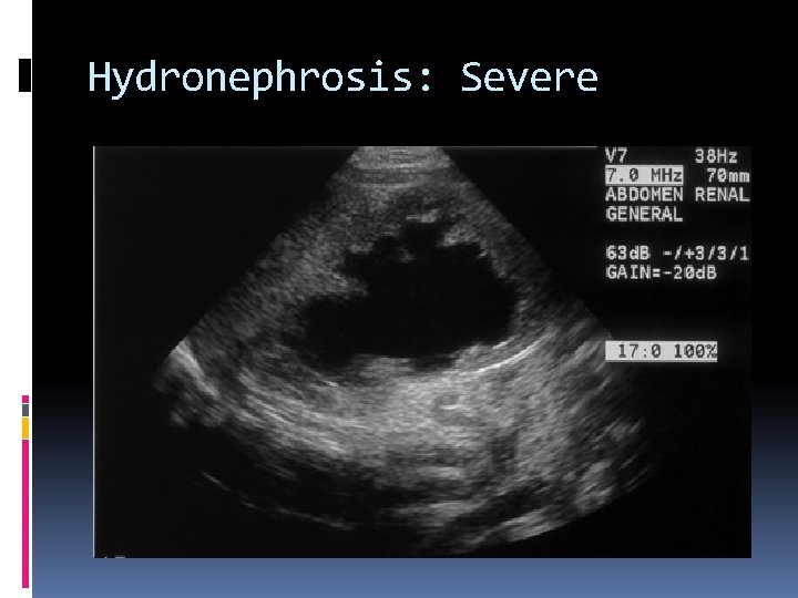 Hydronephrosis: Severe 