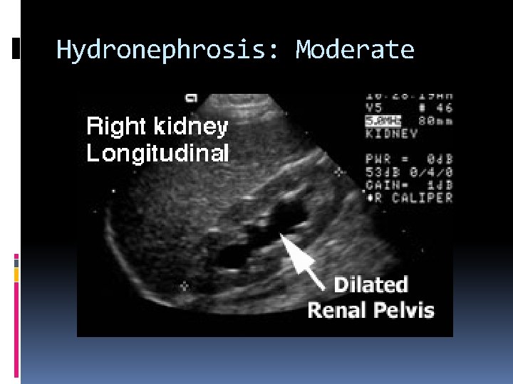 Hydronephrosis: Moderate 