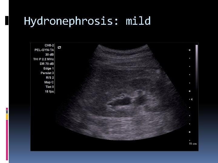 Hydronephrosis: mild 