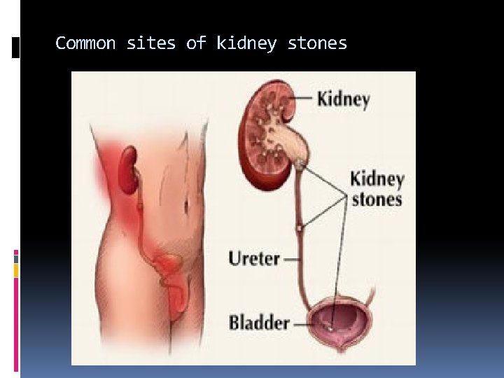 Common sites of kidney stones 