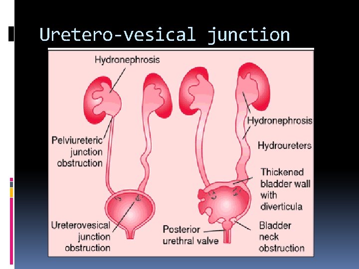 Uretero-vesical junction 