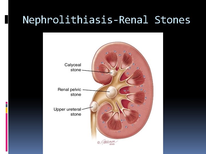 Nephrolithiasis-Renal Stones 