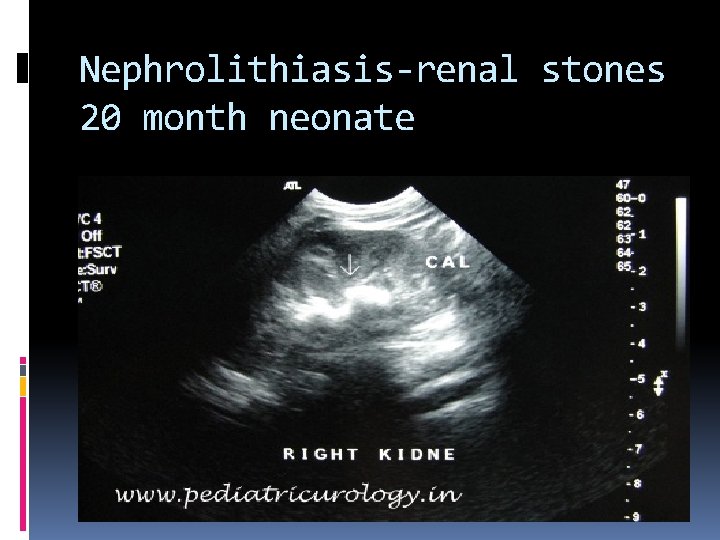 Nephrolithiasis-renal stones 20 month neonate 