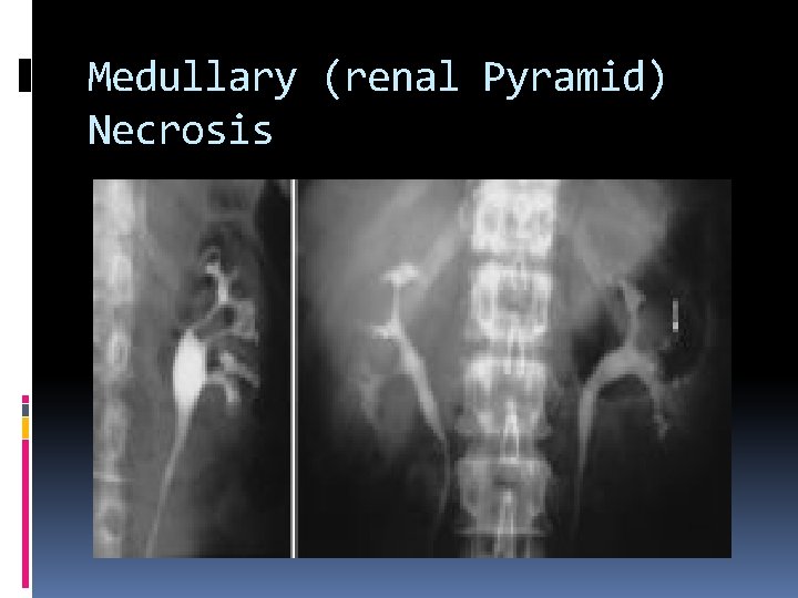 Medullary (renal Pyramid) Necrosis 