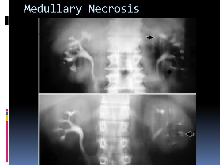 Medullary Necrosis 