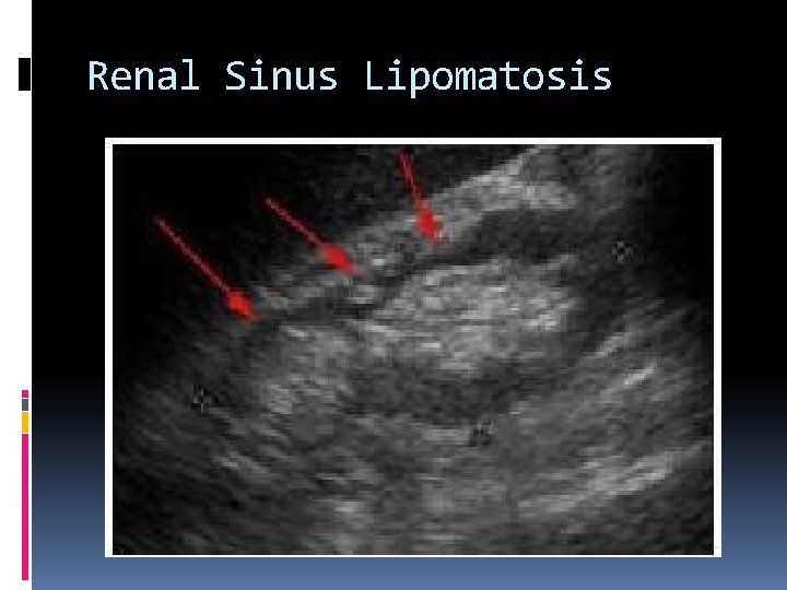Renal Sinus Lipomatosis 