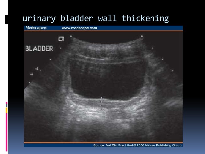 urinary bladder wall thickening 