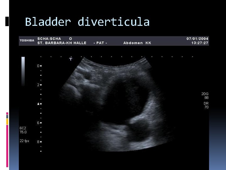 Bladder diverticula 