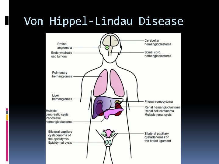 Von Hippel-Lindau Disease 