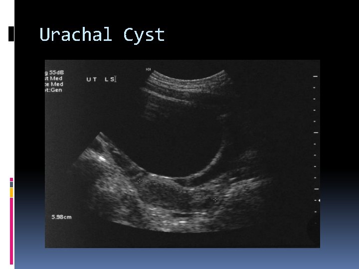 Urachal Cyst 