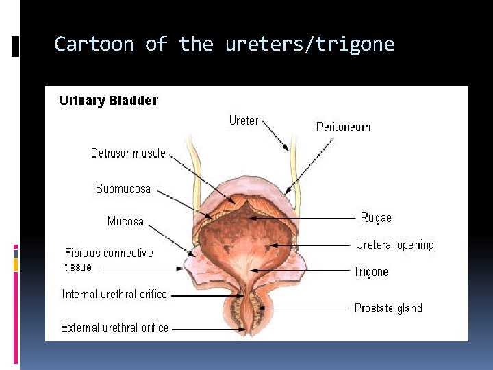 Cartoon of the ureters/trigone 