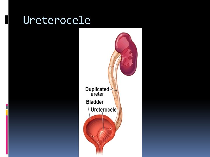 Ureterocele 