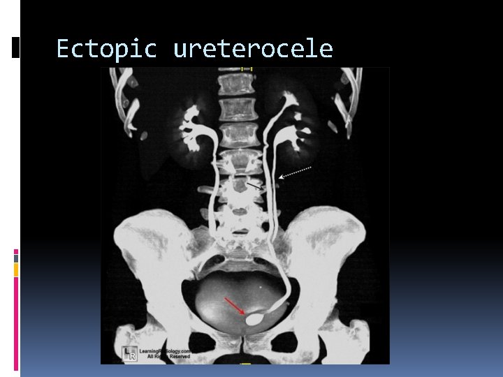Ectopic ureterocele 