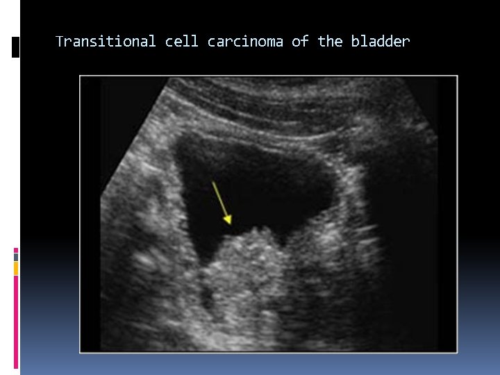 Transitional cell carcinoma of the bladder 