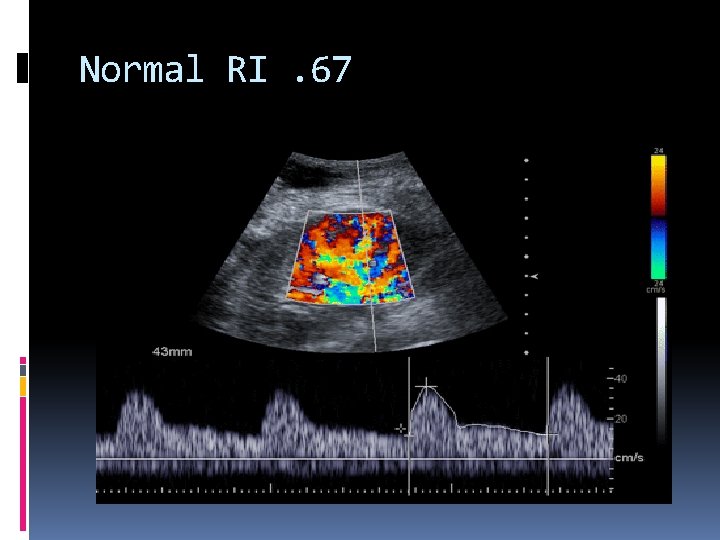 Normal RI. 67 