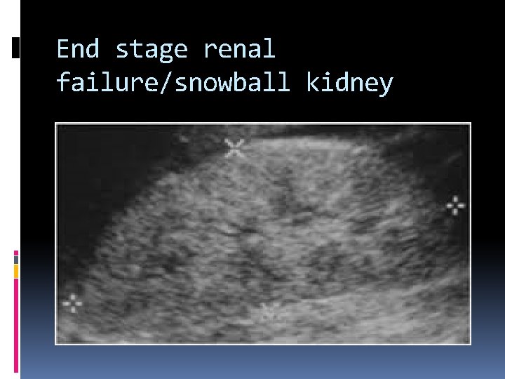 End stage renal failure/snowball kidney 