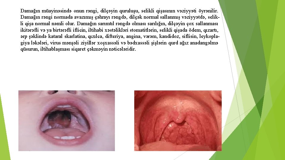 Damağın müayinəsində onun rəngi, dilçəyin quruluşu, selikli qişasının vəziyyəti öyrənilir. Damağın rəngi normada avazımış