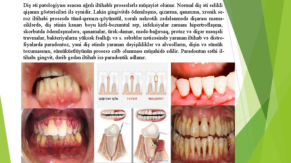 Diş əti patologiyası əsasən ağrılı iltihablı proseslərlə müşayiət olunur. Normal diş əti selikli qişanın