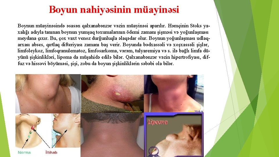 Boyun nahiyəsinin müayinəsi Boynun müayinəsində əsasən qalxanabənzər vəzin müayinəsi aparılır. Həmçinin Stoks yaxalığı adıyla