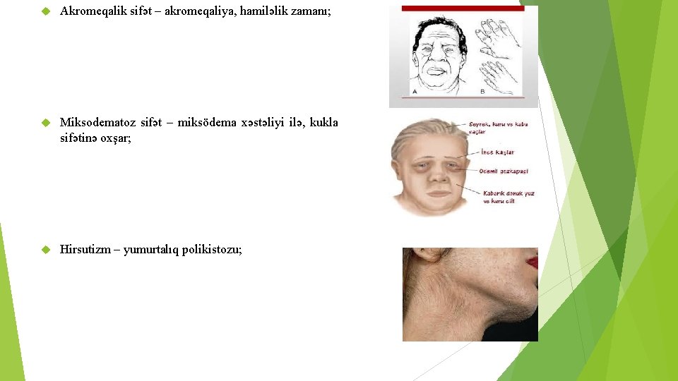  Akromeqalik sifət – akromeqaliya, hamiləlik zamanı; Miksodematoz sifət – miksödema xəstəliyi ilə, kukla