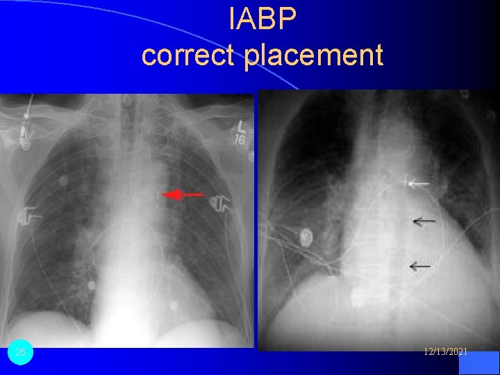 IABP correct placement 25 12/13/2021 