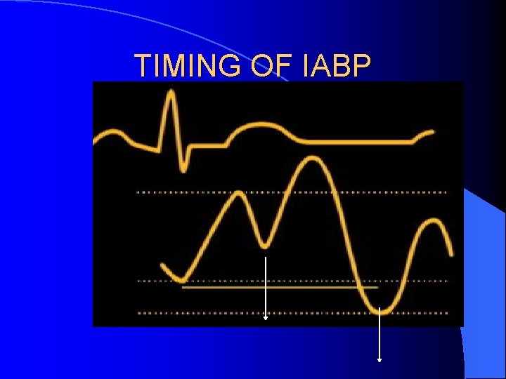 TIMING OF IABP 