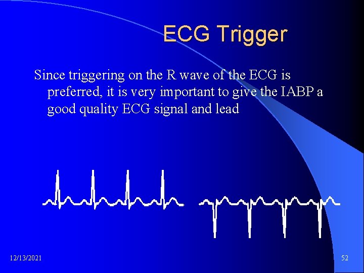 ECG Trigger Since triggering on the R wave of the ECG is preferred, it