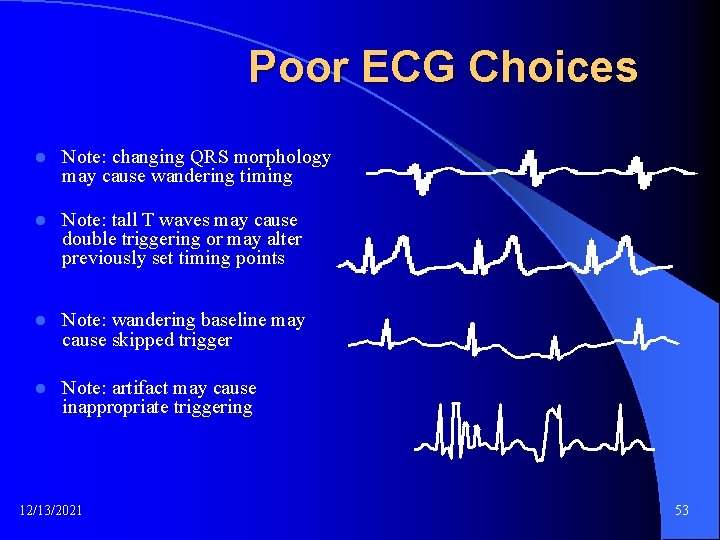 Poor ECG Choices l Note: changing QRS morphology may cause wandering timing l Note: