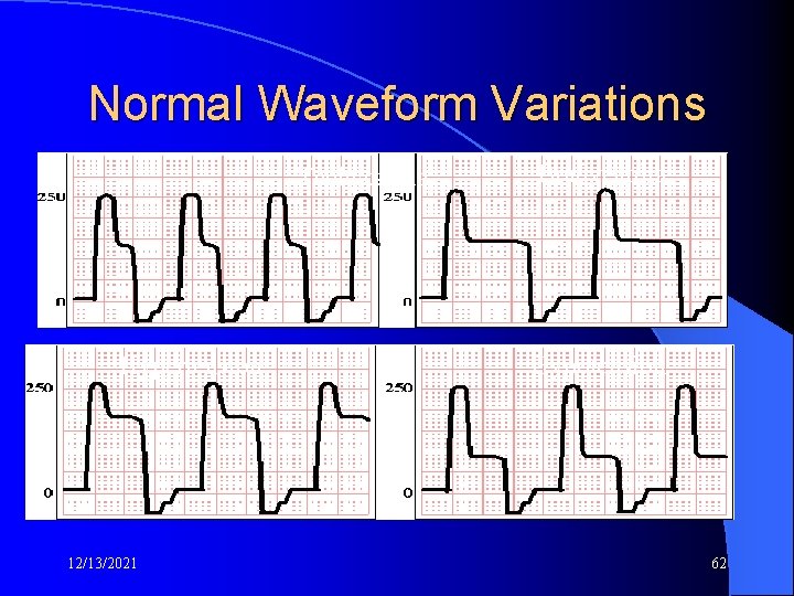 Normal Waveform Variations Tachycardia Hypertension 12/13/2021 Bradycardia Hypotension 62 